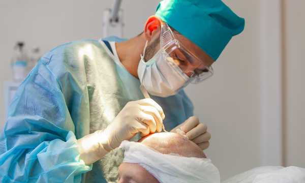 Rodzaje transplantacji włosów w leczeniu łysienia
