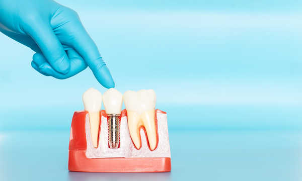 Sterowana regeneracja kości (GBR) – klucz do skutecznej implantacji zębów