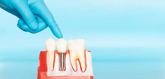 Sterowana regeneracja kości (GBR) – klucz do skutecznej implantacji zębów