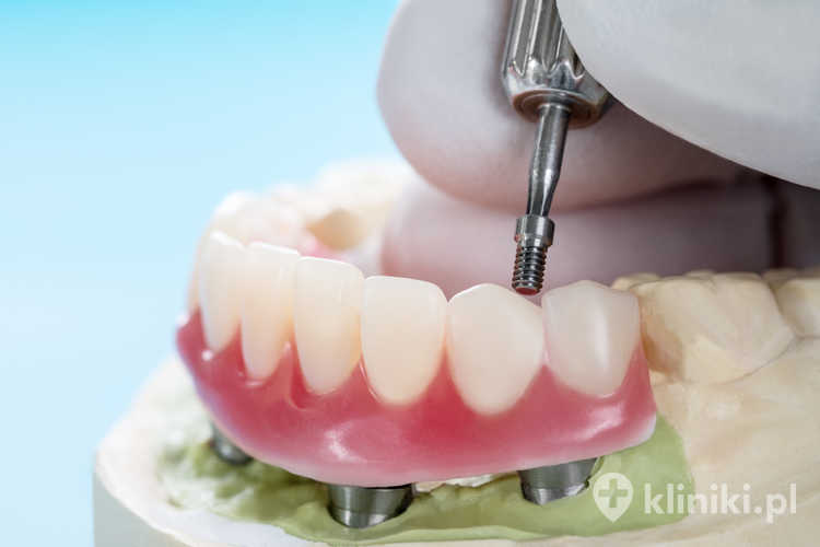 Trwałość implantów