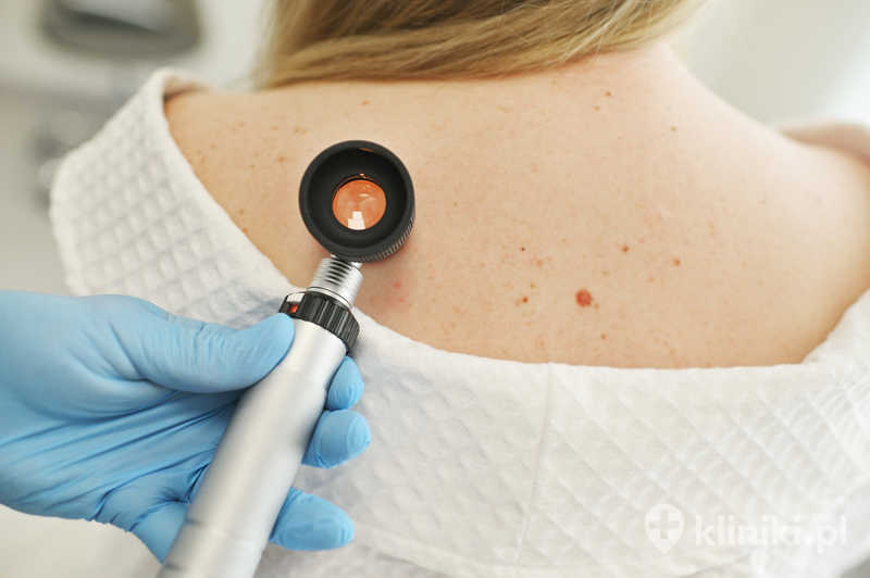 Dermatolog bada pieprzyki i narośla skórne na ciele pacjenta za pomocą specjalnego urządzenia - dermatoskopu