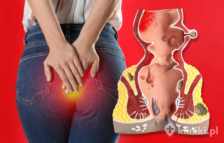 Anatomiczny model odbytnicy z hemoroidami i kobieta cierpiąca na ból