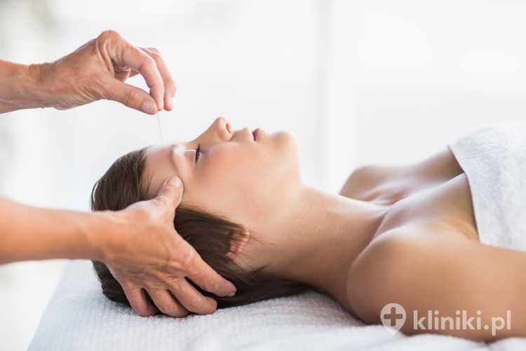 Kobieta poddawana zabiegowi akupunktury w spa