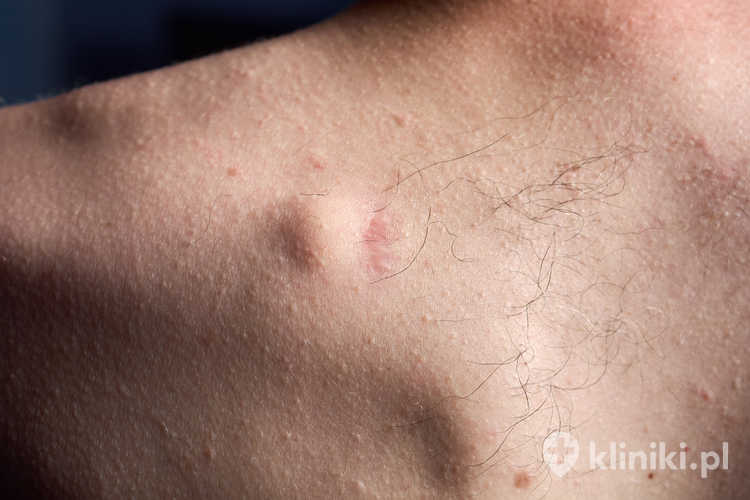 Mały okrągły tłuszczak w górnej części pleców młodego mężczyzny