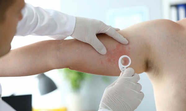 ChatGPT powiedział:

Leczenie pokrzywki polega głównie na stosowaniu leków przeciwhistaminowych, które łagodzą świąd i wysypkę