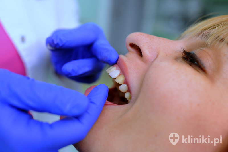 Dentysta zakłada pacjentowi licówki i koryguje zęby Dentysta zakłada pacjentowi licówki i koryguje zęby