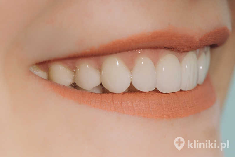 Gotowe ceramiczne korony przednie Gotowe ceramiczne korony przednie