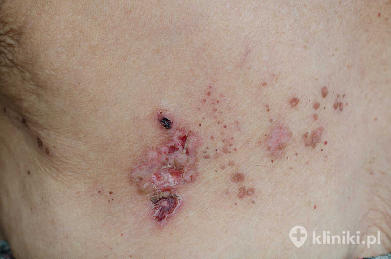 Owrzodzenia na plecach po przechorowaniu półpaśca Owrzodzenia na plecach po przechorowaniu półpaśca