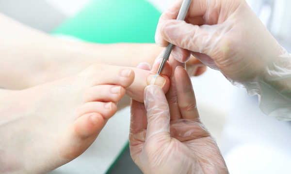 Paznokieć wrastający się z ziarniną  - hipergranulacją wału przypaznokciowego