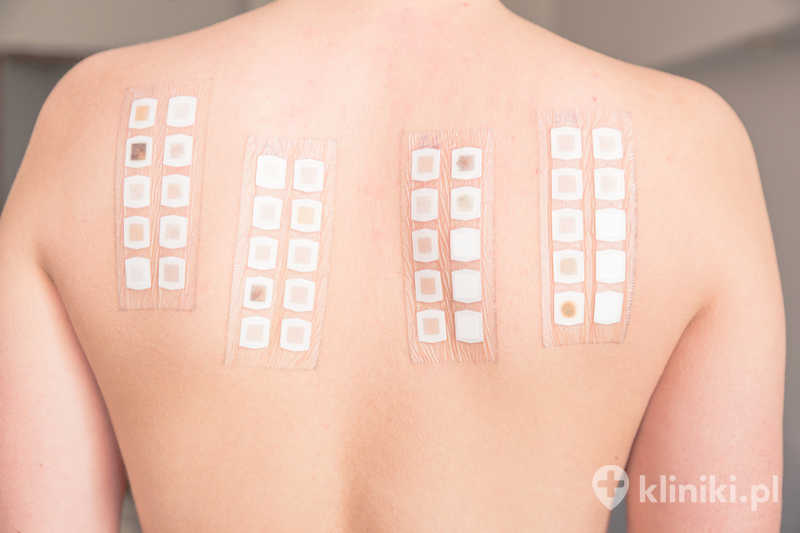 Test na alergię. Test płatkowy na alergię na plecach młodej kobiety