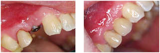 Implantologia przed i po zabiegu