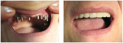 Implanty zębowe przed i po zabiegu