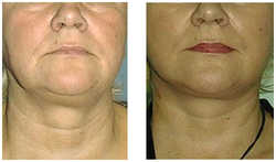 Lifting operacyjny przed i po zabiegu