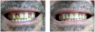 Odbudowa zęba kompozytem przed i po zabiegu