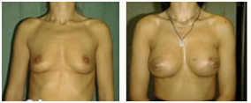 Operacje plastyczne piersi przed i po zabiegu