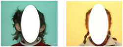 Operacje plastyczne uszu przed i po zabiegu