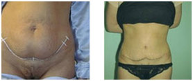 Plastyka brzucha przed i po zabiegu