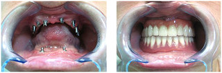 Proteza na belce Doldera na 2 implantach przed i po zabiegu