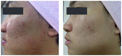 Usuwanie blizn po trądziku przy użyciu Derma Roller
