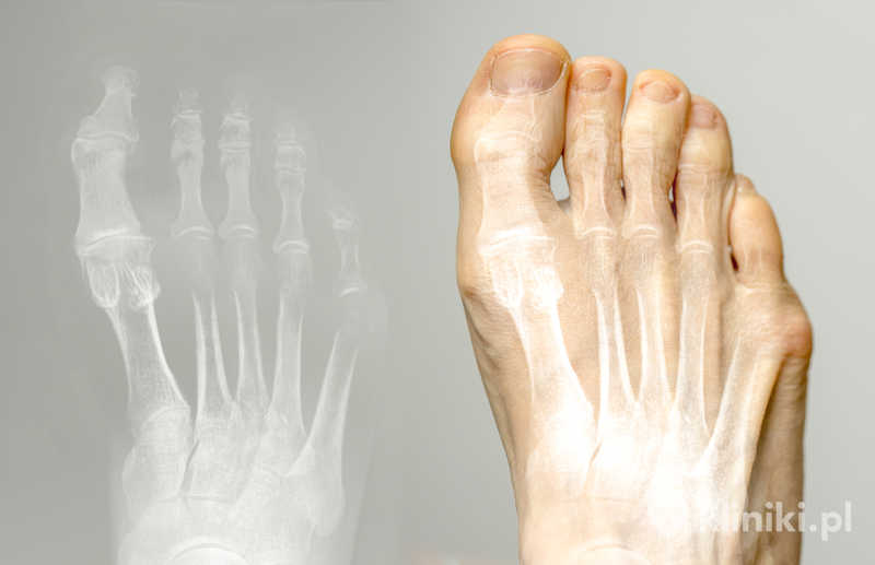 ChatGPT powiedział:
Operacja palucha sztywnego stopy to zabieg chirurgiczny stosowany w zaawansowanych przypadkach choroby zwyrodnieniowej stawu śródstopno-paliczkowego ChatGPT powiedział:
Operacja palucha sztywnego stopy to zabieg chirurgiczny stosowany w zaawansowanych przypadkach choroby zwyrodnieniowej stawu śródstopno-paliczkowego