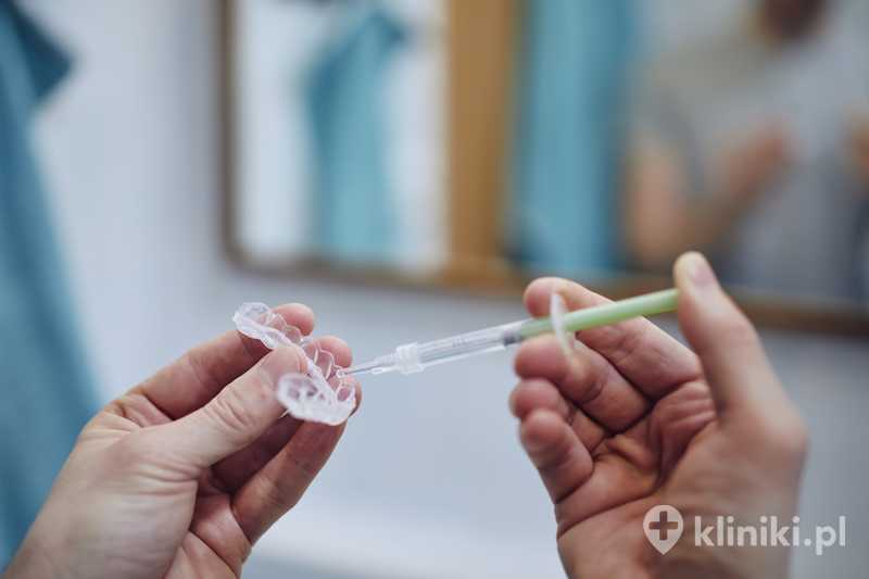 Metoda nakładkowa wybielania zębów jest wygodna, ponieważ pacjent może ją stosować w domu Metoda nakładkowa wybielania zębów jest wygodna, ponieważ pacjent może ją stosować w domu