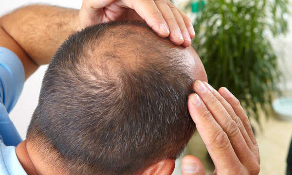 Mężczyzna w średnim wieku zaniepokojony wypadaniem włosów