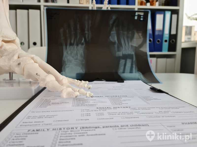 Operacja palucha sztywnego stopy zazwyczaj przeprowadzana jest w znieczuleniu podpajęczynówkowym lub ogólnym i trwa około 60–90 minut Operacja palucha sztywnego stopy zazwyczaj przeprowadzana jest w znieczuleniu podpajęczynówkowym lub ogólnym i trwa około 60–90 minut