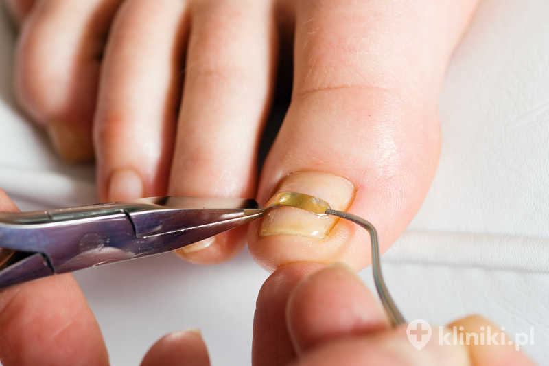 Podstawowy zabieg podologiczny obejmuje opracowanie paznokci Podstawowy zabieg podologiczny obejmuje opracowanie paznokci