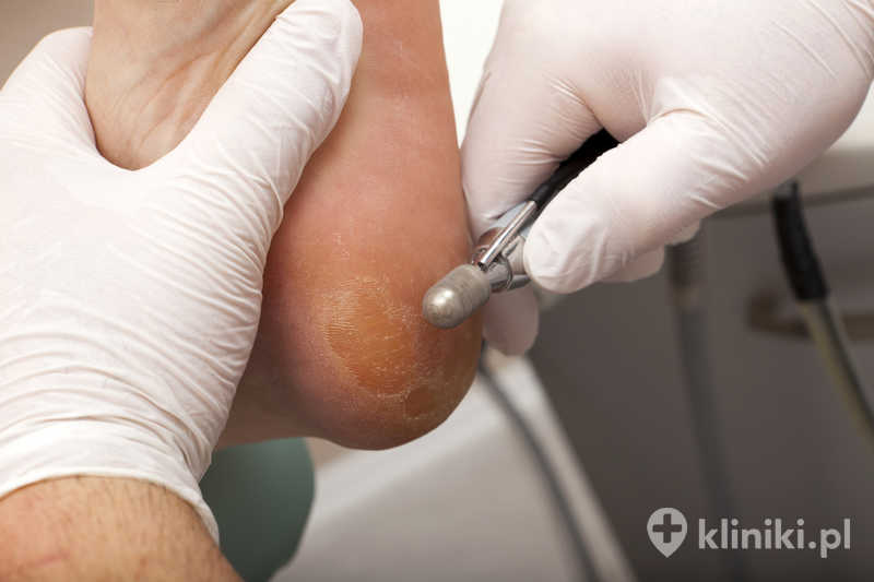 Podstawowy zabieg podologiczny usuwa zrogowaciały naskórek i odciski Podstawowy zabieg podologiczny usuwa zrogowaciały naskórek i odciski