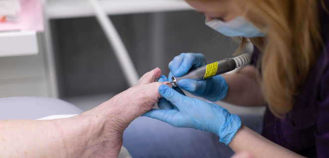 Proste usunięcie płytki paznokciowej, częściowe lub całkowite