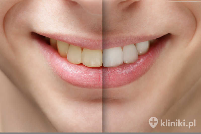 Wybielanie zębów przy użyciu nakładek pozwala na stopniowe rozjaśnianie szkliwa Wybielanie zębów przy użyciu nakładek pozwala na stopniowe rozjaśnianie szkliwa