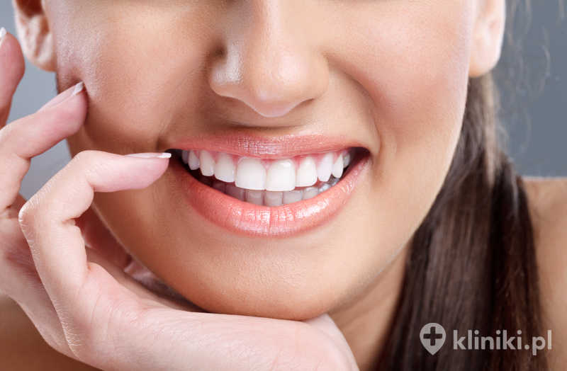 Wybielanie zębów z wykorzystaniem nakładek można dopasować indywidualnie do oczekiwanego efektu Wybielanie zębów z wykorzystaniem nakładek można dopasować indywidualnie do oczekiwanego efektu