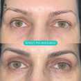 Operacje plastyczne powiek przed i po zabiegu