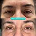 Operacje plastyczne powiek przed i po zabiegu