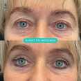 Plastyka chirurgiczna powiek górnych przed i po zabiegu