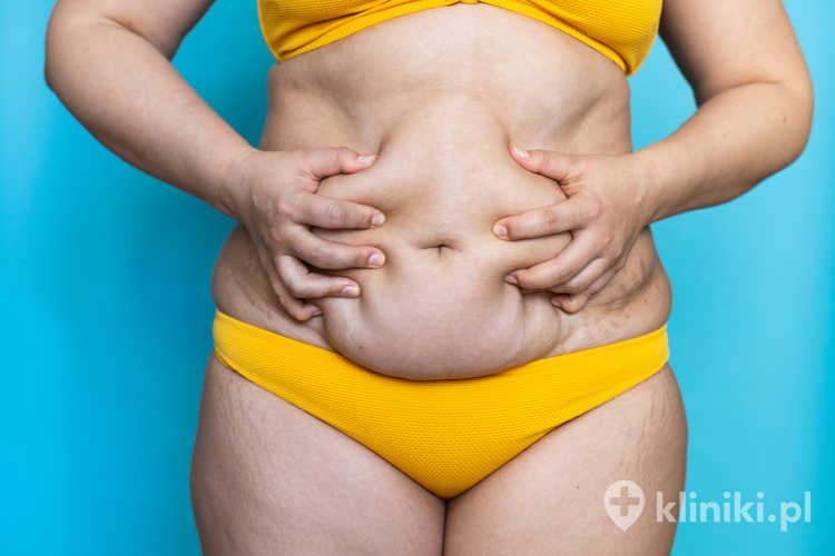 Balonikowanie żołądka polega na umieszczeniu w żołądku specjalnego balonu, który wypełnia jego część i daje uczucie sytości