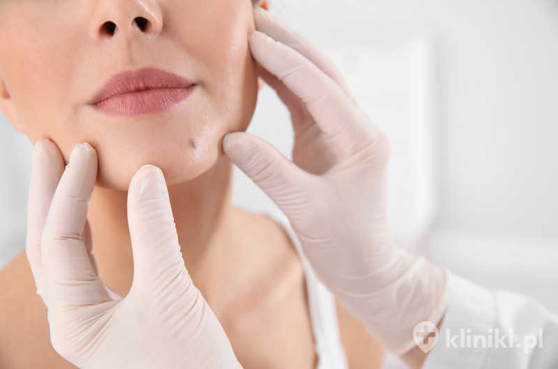 Dermatolog badający znamię  na brodzie pacjenta w klinice Dermatolog badający znamię  na brodzie pacjenta w klinice