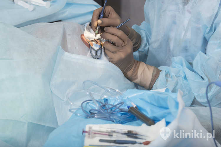 Fakoemulsyfikacja, niszczenie zmętniałej soczewki za pomocą ultradźwięków, okulistyczna chirurgia oka