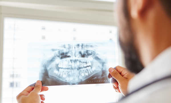 Lekarz trzymający zdjęcie rentgenowskie szczęki i wykonujący diagnostykę chirurgii jamy ustnej