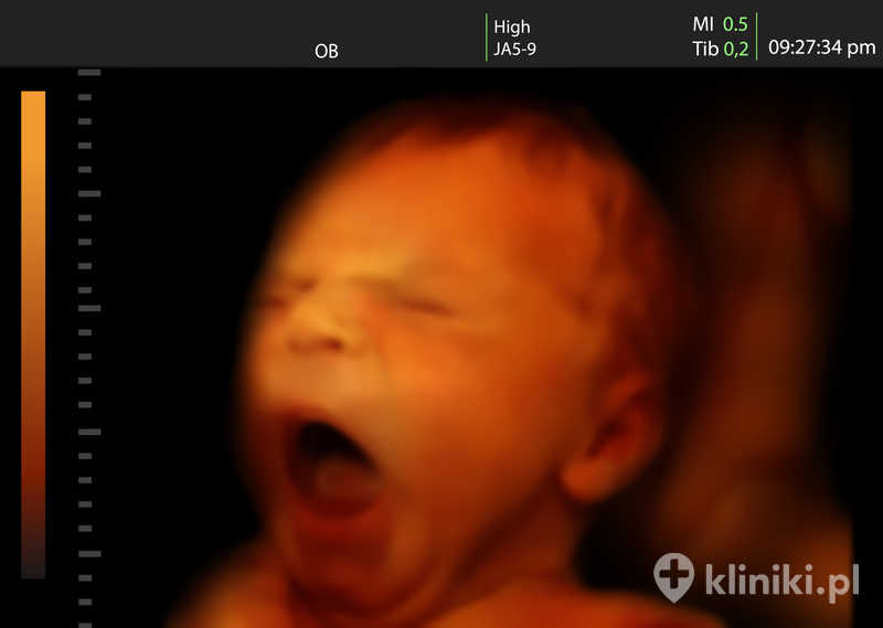 Obraz ziewającego noworodka - USG 3D dziecka w łonie matki