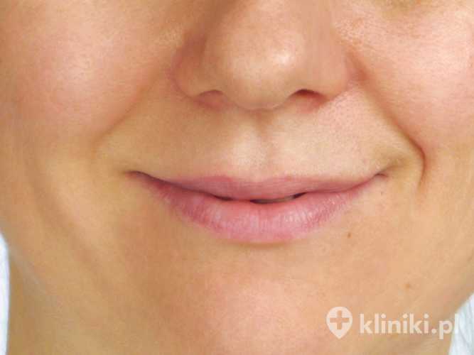 Podniesienie kącików ust kwasem hialuronowym
