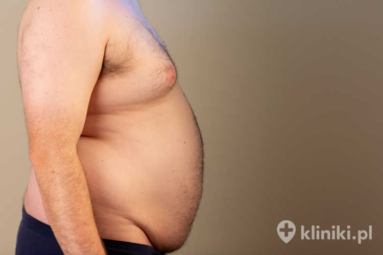 Rękawowa resekcja żołądka polega na chirurgicznym usunięciu dużej części żołądka, co prowadzi do zmniejszenia jego objętości nawet o 70–80%.