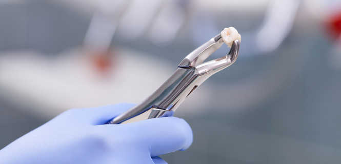 Usunięcie zęba z wypełnieniem zębodołu materiałem kościozastępczym