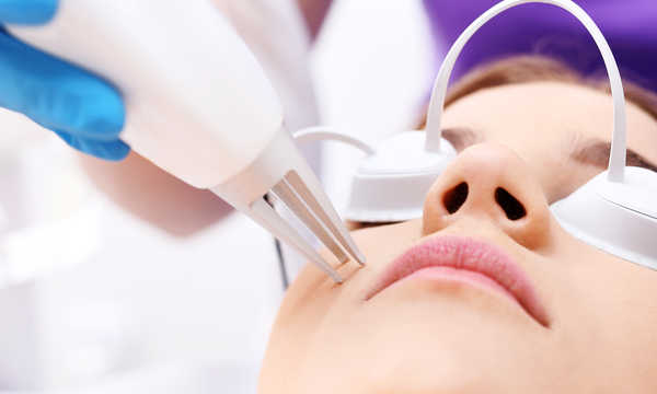 Depilacja laserowa brody