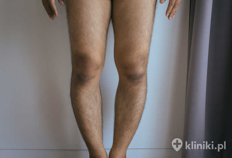 Krzywe i krótkie nogi mężczyznyOperacja wydłużenia kończyn dolnych może trwać kilka miesięcy, w zależności od oczekiwanego efektu