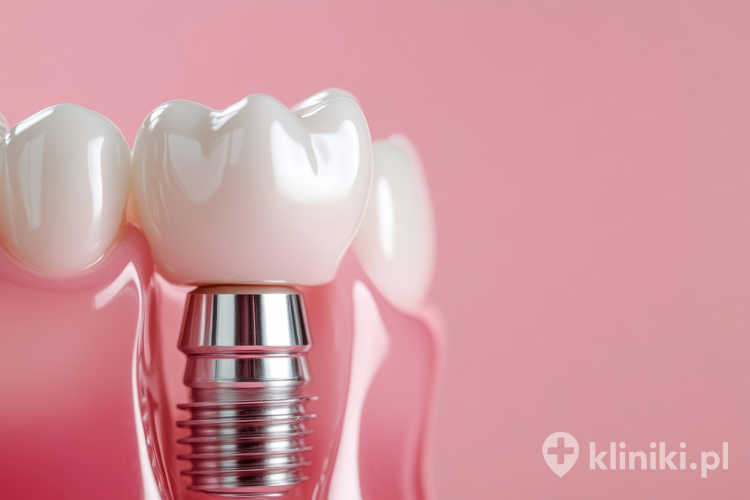 Model implantu dentystycznego z ceramiczną koroną zęba