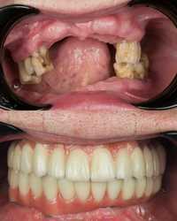 Proteza na 6 implantach przed i po zabiegu