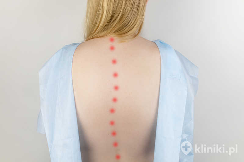 Terapia schorzeń kręgosłupa często opiera się na rehabilitacji, fizjoterapii oraz farmakoterapii przeciwbólowej