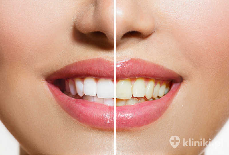 Wybielanie przy użyciu lampy przynosi szybkie efekty już po jednej wizycie Wybielanie przy użyciu lampy przynosi szybkie efekty już po jednej wizycie