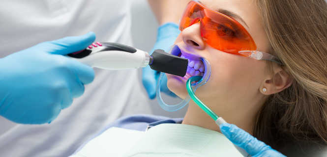 Wybielanie zębów lampą - jednowizytowe
